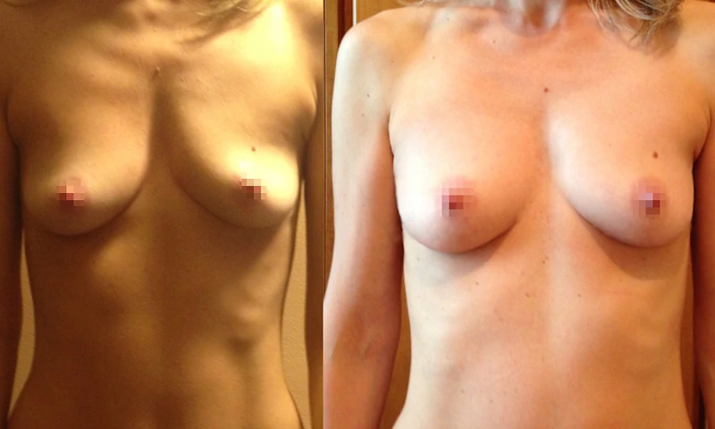 lipofilling seno prima e dopo